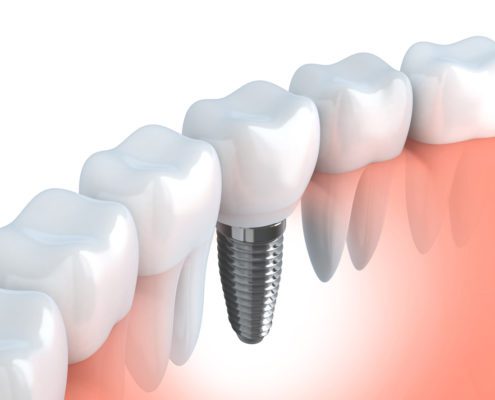 Dental Implants at Dentistry on Merivale